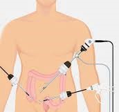 appendectomy_2.jpg
