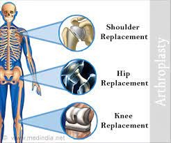 arthroplasty1.jpg