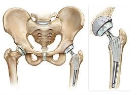 arthroplasty2.jpg