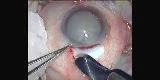 cataract-surgery.jpg