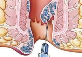 hemorrhoidectomy.jpg