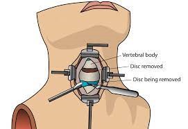 herniated-cervical-discectomy.jpg