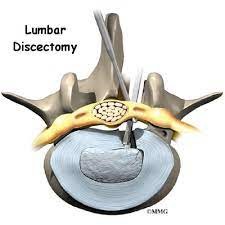 lumbar-discectomy.jpg