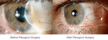 pterygium-surgery.jpg